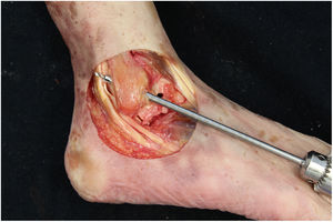 Right ankle. Hole drilled in the anatomical mark of the fibular tunnel with an angle of 50° in distal-anterior to proximal-distal direction.