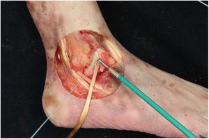 Right ankle. Insertion of the EHL tendon plasty into the blind talar tunnel and subsequent fixation with a 4.75 mm anchorage.