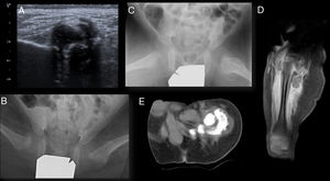 Imaging tests. (a) Ultrasound scan of the left hip. Hyperechogenic image with a posterior acoustic shadow corresponding to a large calcification in the interior of the left gluteal muscles. (b) and (c) anteroposterior and lateral projection of the frog leg view of both hips. Increased density of the soft tissues adjacent to the cortex medial and lateral to the left femur head and neck, with cortical insufflation in the proximal femur. (d) Magnetic resonance image of the left hip. Continuous periosteal reaction in the femur with surrounding oedema and intramuscular calcification in the thickness of the muscles in the origin of the thigh. (e) CT of the left hip. Large calcification in the thickness of the muscles in the origin of the thigh, lateral, posterior, and medial to the femur, without being in contact with it. A bright zone between the lesion and the underlying bone, the presence of intact cortical bone, the location adjacent to the axis of a bone and the denser calcification in the lesion periphery are valuable radiographic findings for differential diagnosis vs bone malignity.
