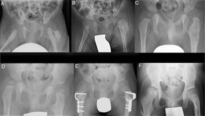 Series of X-ray images during follow-up. (a–c) Evolution of the calcification in the thickness of the gluteal muscles and morphological changes at the level of the proximal femur at one month, 2 and 9 months, respectively. (d) Complete remodelling of the proximal femur at 18 months. (e) 3 years: bilateral proximal derotatory and modifying femoral osteotomy. (f) 8 years: hips reduced without evidence of recurrence of the lesion.