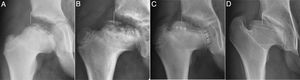 Series of X-ray images of a cases of Perthes with onset at 4 years old. (a) Early re-ossification phase developing over 18 months. Continuous vertical line or Perkins’ line. The discontinuous line marks the cephalic physis. (b) Start of the physeal angulation and the incipient appearance of 2 epiphyseal re-ossification nuclei. (c) Note the greater extrusion, physeal closure of the lateral nucleus with white arrows and productive physis in the medial nucleus with black arrows. A chondral zone without ossification is visible between both nuclei. (d) Final result at 16 years. Coxa magna, flat and extruded. Showing maximum physeal angulation, cephalic extrusion and trochanter overgrowth. Stulberg grade IV.