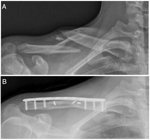 A) Preoperative clavicle radiograph with 45° cephalic tilt showing a Robinson 2B2 fracture (displaced, comminuted and segmental) in a 17-year-old rugby player. B) Postoperative radiograph showing bone healing of the clavicular fracture three months after surgical fixation with a precontoured locking plate and three interfragmentary screws.