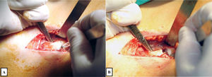 Surgical technique for intramuscular lengthening of the rectus femoris at the proximal level. A) Visualisation and initiation of section of the intramuscular tendon portion of the rectus femoris at the proximal level. B) B) Separation of the ends of the intramuscular portion of the tendon, respecting the continuity of the muscle belly located posteriorly.