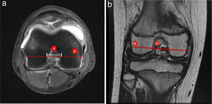 (a) Axial intercondylar notch width index. On axial section where the popliteal recess is observed in greater depth, in fat saturation sequence, a line is drawn marking the edge of the medial and lateral femoral condyles (dotted black line) and a line parallel to this line that goes from the edge of the popliteal recess to the opposite femoral edge (B), and at this height the width of the intercondylar notch is measured (white line), obtaining values for calculation of B/A index. (b) Coronal intercondylar notch width index. On coronal section, where the popliteal recess is observed in greater depth in T2 sequence, the red line of femoral diameter (B) is drawn parallel to the edges of the femoral condyles, and at that level the width of the intercondylar notch is measured (red dots A).