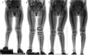 Patient aged four years with diagnosis of fibular hemimelia. A) Length discrepancy. B) Temporary epiphysiodesis. C) Progressive deformity after partial removal. D) Correction of angular deformity.
