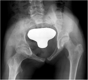 Boy, 10 years old. Involvement of proximal femoral epiphysis. Grade 1. Two surgical debridements required. Sequelae were a flexion of the hip 40°, dysmetria and limp, and also irregularity in the joint surface in plain radiography.