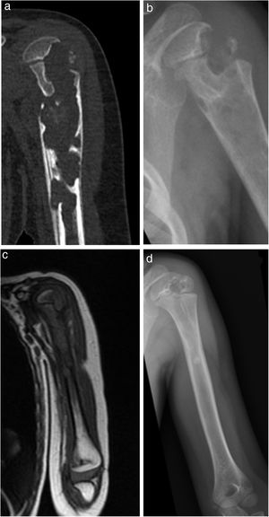 Girl, 3 years old. Osteoarthritis of the shoulder with involvement of proximal humerus epiphysis. Grade 2. Two surgical debridements performed. Highly satisfactory clinical evolution with no sequelae. A slight epiphysometaphyseal defect with correct joint surface in radiography.