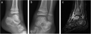 Girl, 2 years old. Osteoarthritis with involvement of the astragalar dome. Grade 1. Two arthroscopies were performed for obtaining synovial and osseous material, together with lavage. No clinical or radiographic sequelae.