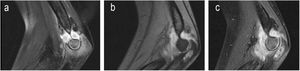 Teenager, 14 years. Osteoarthritis with epiphyseal abscess of the ulna. Grade 1. Synovial and open bone biopsy was performed. The last articular balance was limited: flexion 90°, extension −70° and normal pronosupination. Loss of subsequent follow-up.