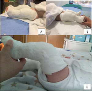 Images of conservative treatment using serial casts in the same patient. A and B: right and left knee casts are shown at the start of treatment. C: cast after 3 weeks.