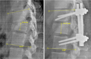 Measurement of the Cobb height and angle. Lumbar radiography in lateral projection pre and post surgery to outline taking of measurements of Cobb height and angle. Height of the vertebral body, measured by taking the distance between the upper and lower disk of the fractured vertebra, expressed in millimetres. Cobb angle: this is the angle resulting from the intersection of the two 90° angles taking as repair the upper disk of the upper vertebra and the lower disk of the lower vertebra compared with the fractured vertebra, expressed in grades.