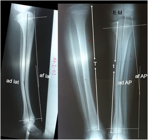 da AP: tibial diaphyseal angle in anteroposterior projection; da lat: tibial diaphyseal angle in lateral projection; pa AP: physeal angle in anteroposterior projection; pa lat: physeal angle in lateral projection; MS: mechanical axis of the limb; T: length of the healthy tibia; t: length of the PMTB.