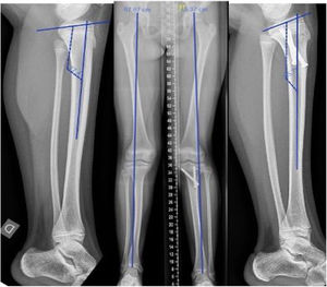 Female aged 12.5 years right PMTB. Discrepancy of 3cm treated by epiphysiodesis of the healthy limb with screws using the Metaizeau technique at the age of 9.5 years. Control at 3 years showing a reduction of the discrepancy to 1.5cm with associated valgus and procurvatum deformity of the healthy knee.
