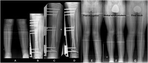 (A) PMTB in a 12-year-old male. Dysmetria of 5cm and valgus of 13°. (B–D) Treatment with monolateral external fixation for proximal tibial bone elongation of 7cm and mediodiaphyseal shortening varising osteotomy. (E) Result after compensated discrepancy with residual valgas. (F) Guided medial proximal tibial growth. (G) Final result at 15 years.