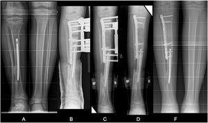 (A) 12-year-old male. PMB of right tibia operated at 3 years in his country of origin by mediodiaphyseal osteotomy of the distal tibia. Dysmetria of 5cm. PT synostosis. (B and C) Tibial lengthening of 5cm on slotted plate. (D–F) Final result.