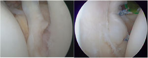 Arthroscopic image of the Bankart lesion and result after capsulolabral repair.