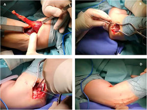 (A) Preparation and isolation of the distal tendon. (B) Lateral approach and exposure of the radial tuberosity. (C) Tendon anchoring. (D) Final suturing.