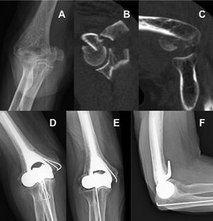 Case 3. (A) Initial X-ray. (B and C) Sagittal reconstruction of computerised tomography prior to surgery. (D) Radiologic control 3 months after surgery. (E and F) Radiologic control after 5 years, at end of follow-up.