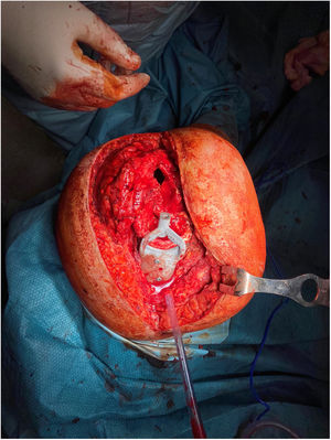 Intraoperative image, with 3D guide applied to the femur for drilling the intracanal cement in a controlled manner.