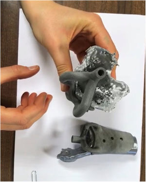3D guides on three-dimensional reconstruction of the patient
