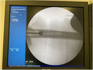 Circular 11mm drill perfectly centred in the femoral canal with the help of the 3D guide.