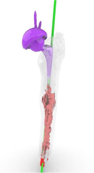 In purple, stem moved (Exeter stem length 95mm). In red, the cement which prevents implantation of a larger stem. In green, design of the desired trajectory of the drill to remove cement and enable larger stem to be attached.
