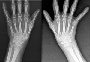 Anteroposterior X-ray of wrists: fragmentation and sclerosis of both scaphoid bones.