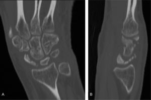CT of left wrist. A. Coronal image with small, multi-fragmented and sclerosed scaphoid. B. Sagittal image showing dorsal deviation of the lunate bone with small, hyperattenuated, multi-fragmented scaphoid bone.