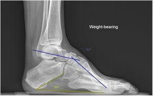 Preoperative X-ray of patient 6, showing the measurement of Meary’s angle (blue) and calcaneal inclination (yellow).