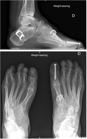 Postoperative radiographic control of patient 6, showing the calcaneal osteotomy staples, osteotomy of the first metatarsal and arthrodesis of the hallux.