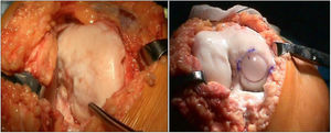 A 26-year-old woman with sequelae of osteochondritis dissecans operated twice. Result of surgical intervention using the Maxioats® technique.