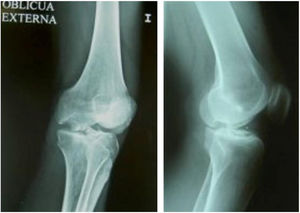 Radiological image of the chondral defect sustained by a firearm.
