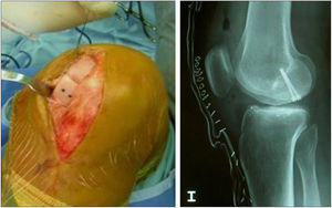 Same patient as Fig. 5. Result of manually milled graft fixed with Herbert screws.