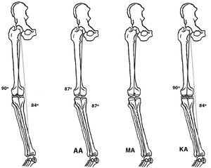 Native knee in varus and anatomical alignment (AA), mechanical alignment (MA) and kinematic alignment (KA). Note the different direction and thickness of the tibial and femoral osteotomy between the three types of alignment.