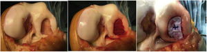Curetted chondral defect, later filled with cancellous bone graft and finally sealed with Cartimax-Matricel mesh.