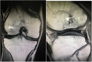 Coronal and sagittal magnetic resonance imaging after 2 years.
