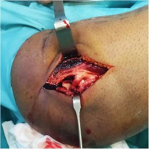 Lateral approach, note the significant soft tissue involvement with tearing of the muscle, LLC involvement and capsular rupture with direct exposure of the radiocapitellar joint.