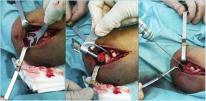 Identification of the isometric point to place the axis pin.