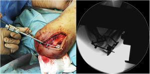 Locking of the mechanism checking joint congruence under fluoroscopic control.