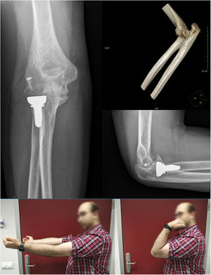 Case with heterotopic ossification after 12 months of follow-up. No clinical repercussions with full active joint balance.