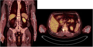 Coronal and axial slices of the PET/CT with 25-fluorodesoxyglucose, where enhanced uptake is seen at right vertebral half body level of L1.
