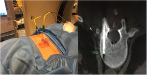 PMT TC guided cryoablation technique in right vertebral half body of L1.
