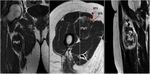 Coronal, axial and sagittal slices of NMR with PMT in right groin. SFA: superficial femoral artery; SFV superficial femoral vein.