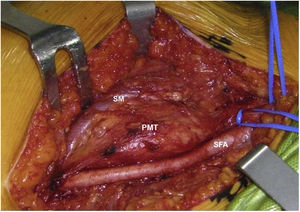 Surgical right groin PMT photo. SFA: superficial femoral artery; SM: sartorial muscle; PMT: phosphaturic mesenchymal tumour partially covering superficial femoral vein (at a deeper level).