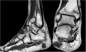 Sagittal and coronal slices of NMR with Matt footpad heel level.