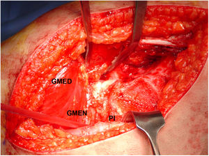 Surgical approach. The capsular approach through a trochantic inverted osteotomy with anterosuperior exposure provides excellent viewing of the hip joint. GMED: gluteus medius; GMEN: gluteus minimus; PI: pyriform muscle.