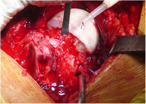 Cam type correction of deformity. The image shows the correction of a cam type deformity with an osteochondroplasty of the femoral head-neck union.