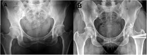 Pre and postoperative images of a pincer type deformity. A) AP radiologic image of a patient aged 46 years with bilateral pincer type FAI with symptomatic left hip that shows prominent acetabular edges; Tönnis grade I. B.) AP radiographies 12 months after SHD to correct the pincer type deformity that shows the postoperative result after osteoplasty of the acetabular edge and labral repair of the left hip.