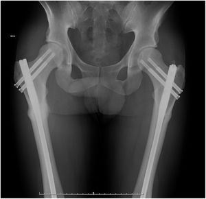 Control X-ray after one year.