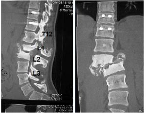 CT scan: collapse of the L1–L2 somas with damage to all three columns and scoliosis-like deformity.